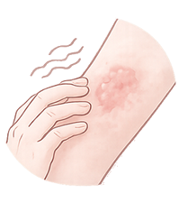 湿疹・かぶれ・じんましん