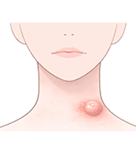 できもの・粉瘤・いぼ