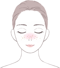 アレルギー・花粉症