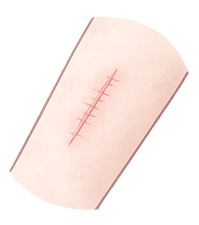 外傷の傷あと・やけど跡・ケロイド