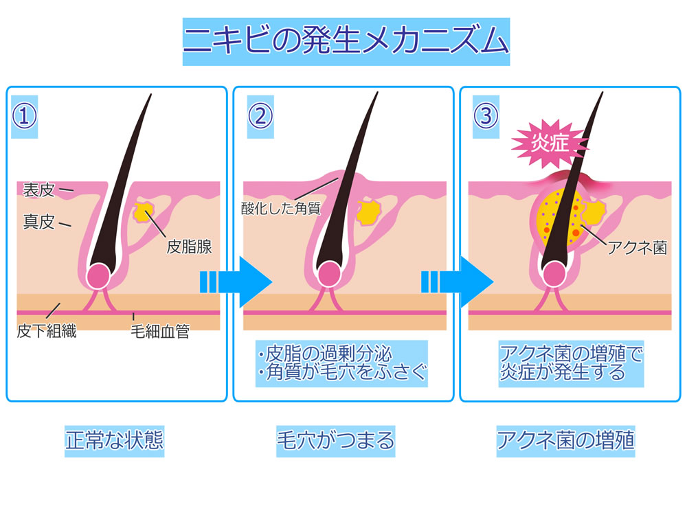 ニキビができる原因とニキビの種類