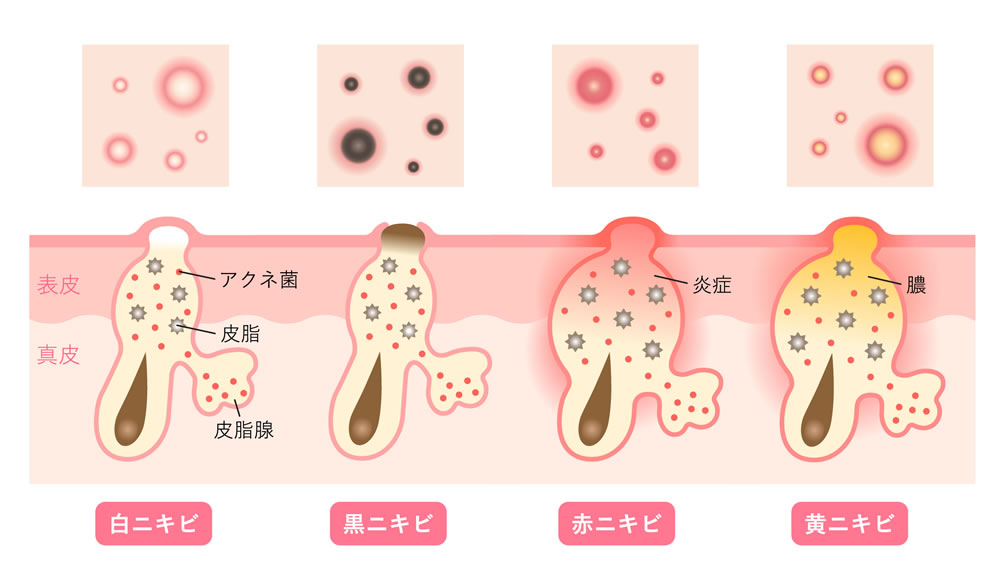 ニキビの種類