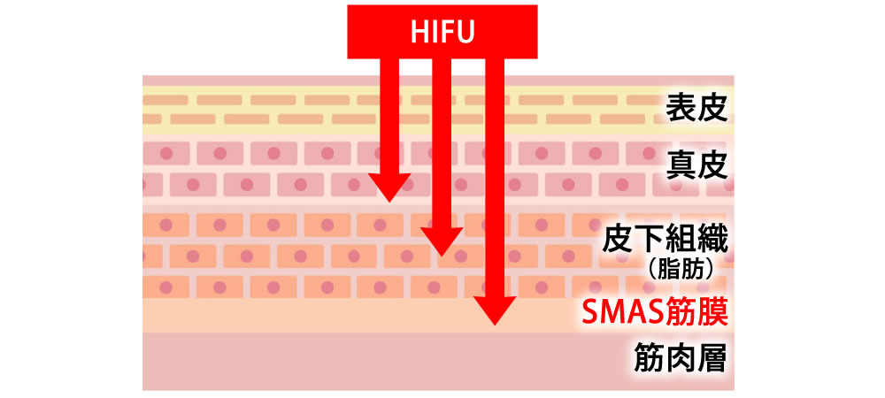 HIFU(ハイフ)治療のメカニズム