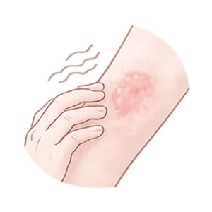 湿疹・かぶれ・じんましん