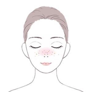 アレルギー・花粉症