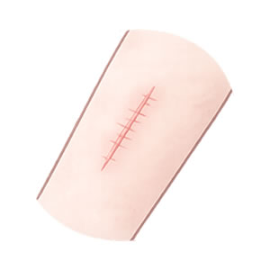 外傷あと・やけど跡